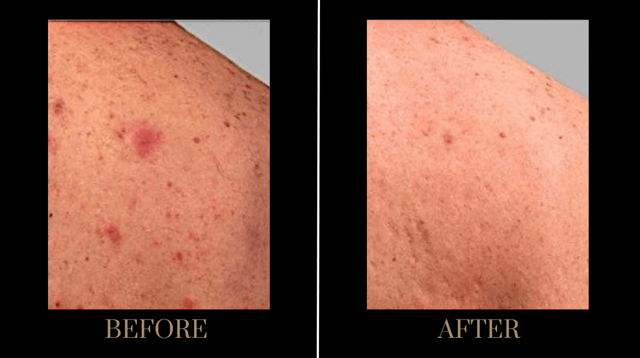 Morpheus8 result at PURE Medical Spa in Meridian, ID