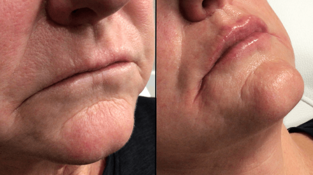 Lip Filler result at PURE Medical Spa in Meridian, ID