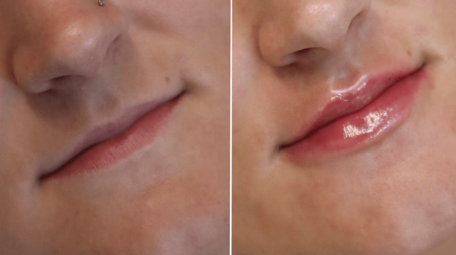 Lip Filler result at PURE Medical Spa in Meridian, ID