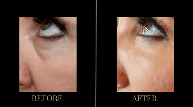 Jawline Filler result at PURE Medical Spa in Meridian, ID