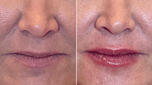 Lip Filler result at PURE Medical Spa in Meridian, ID