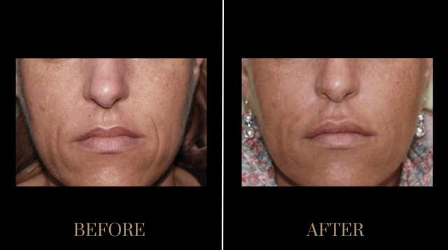 Morpheus8 result at PURE Medical Spa in Meridian, ID
