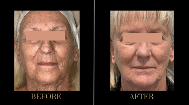 Chemical Peel result at PURE Medical Spa in Meridian, ID