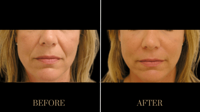 Jawline Filler result at PURE Medical Spa in Meridian, ID