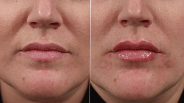 Lip Filler result at PURE Medical Spa in Meridian, ID
