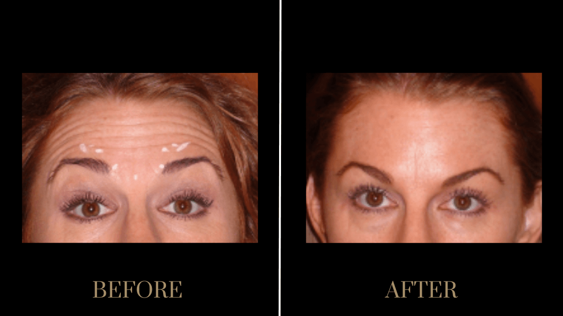 PURE Medical Spa result — Meridian, ID