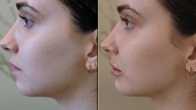 Lip Filler result at PURE Medical Spa in Meridian, ID