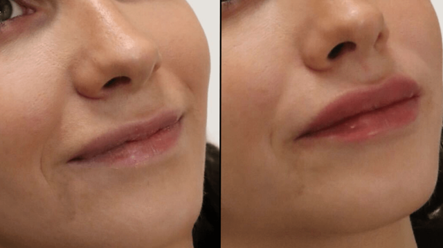 Lip Filler result at PURE Medical Spa in Meridian, ID