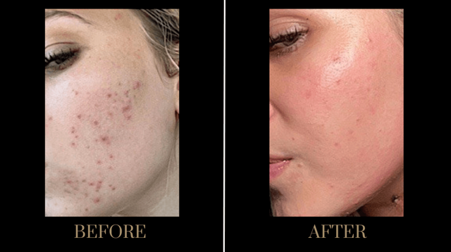 Morpheus8 result at PURE Medical Spa in Meridian, ID