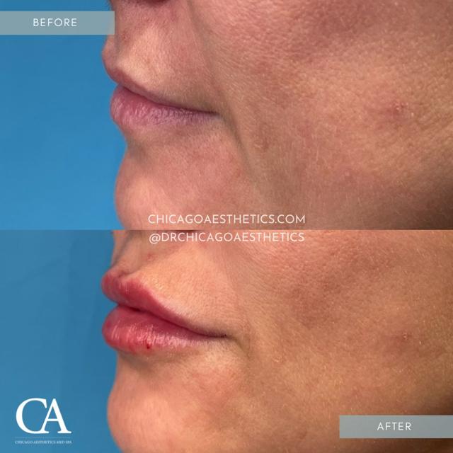 Lip Filler result at Chicago Aesthetics Surgery & Med Spa in Chicago, IL