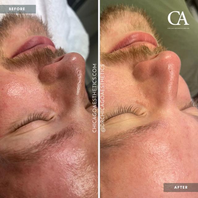 Functional Rhinoplasty result at Chicago Aesthetics Surgery & Med Spa in Chicago, IL