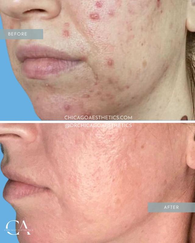Microneedling result at Chicago Aesthetics Surgery & Med Spa in Chicago, IL