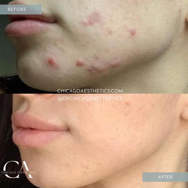 Laser Skin Resurfacing result at Chicago Aesthetics Surgery & Med Spa in Chicago, IL