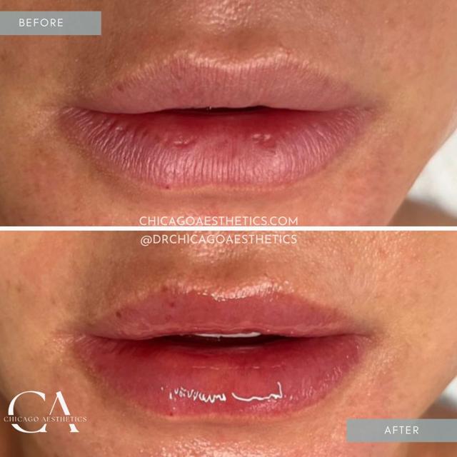 Lip Filler result at Chicago Aesthetics Surgery & Med Spa in Chicago, IL