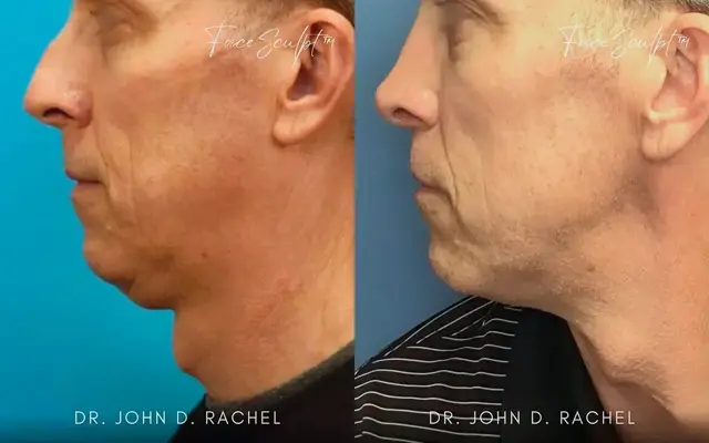 Neck Lift result at Chicago Aesthetics Surgery & Med Spa in Chicago, IL