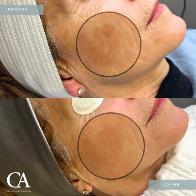 Laser Skin Resurfacing result at Chicago Aesthetics Surgery & Med Spa in Chicago, IL