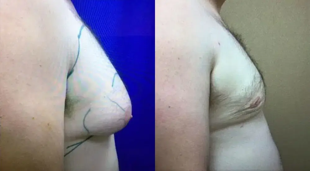 Chicago Aesthetics Surgery & Med Spa gynecomastia result — Chicago, IL