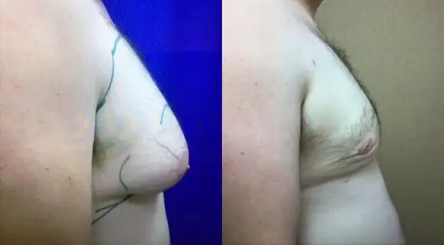 Gynecomastia Surgery result at Chicago Aesthetics Surgery & Med Spa in Chicago, IL