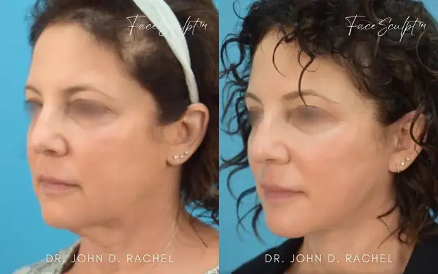 Facelift result at Chicago Aesthetics Surgery & Med Spa in Chicago, IL