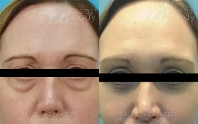 Blepharoplasty result at Chicago Aesthetics Surgery & Med Spa in Chicago, IL