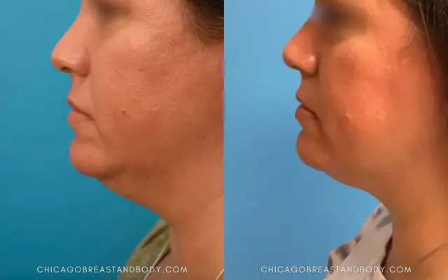 Neck Liposuction result at Chicago Aesthetics Surgery & Med Spa in Chicago, IL