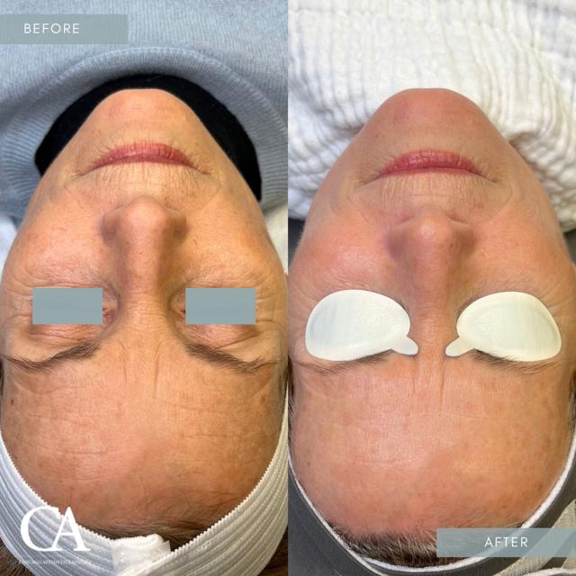 Laser Skin Resurfacing result at Chicago Aesthetics Surgery & Med Spa in Chicago, IL