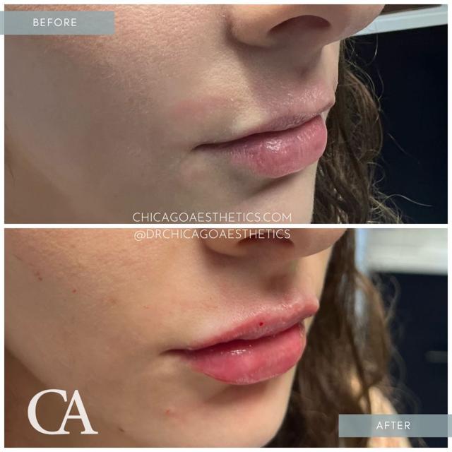 Lip Filler result at Chicago Aesthetics Surgery & Med Spa in Chicago, IL