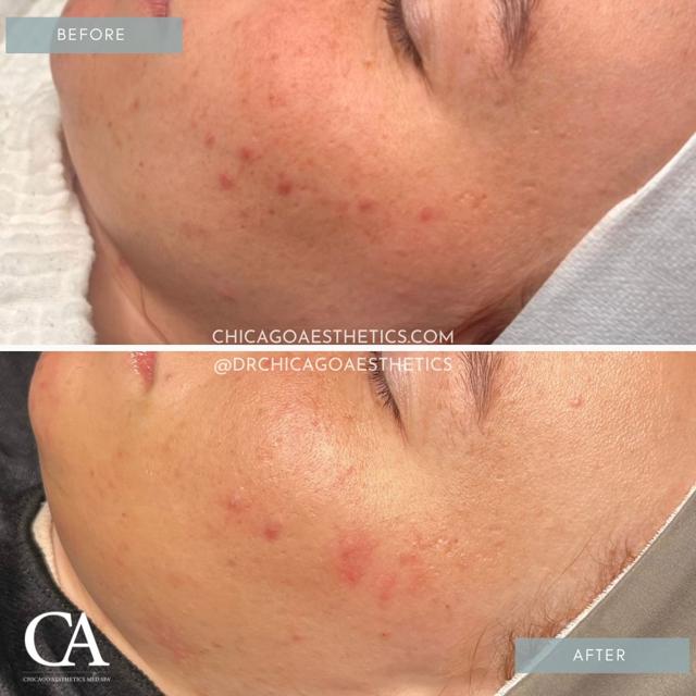 Laser Skin Resurfacing result at Chicago Aesthetics Surgery & Med Spa in Chicago, IL