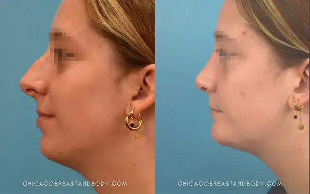 Chin Implant result at Chicago Aesthetics Surgery & Med Spa in Chicago, IL