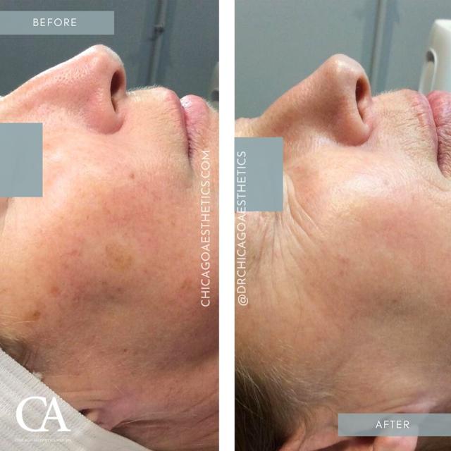 Laser Skin Resurfacing result at Chicago Aesthetics Surgery & Med Spa in Chicago, IL