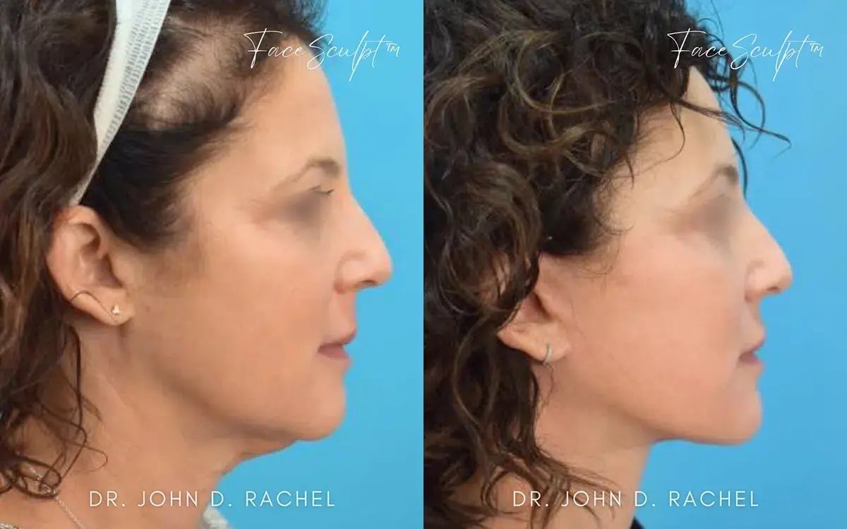 Chicago Aesthetics Surgery & Med Spa facelift result — Chicago, IL
