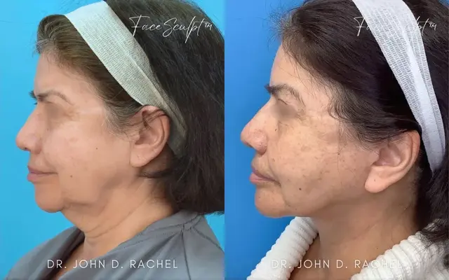 Neck Lift result at Chicago Aesthetics Surgery & Med Spa in Chicago, IL
