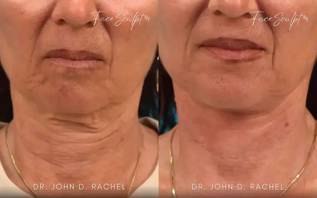 Neck Lift result at Chicago Aesthetics Surgery & Med Spa in Chicago, IL