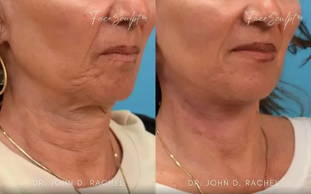 Neck Lift result at Chicago Aesthetics Surgery & Med Spa in Chicago, IL