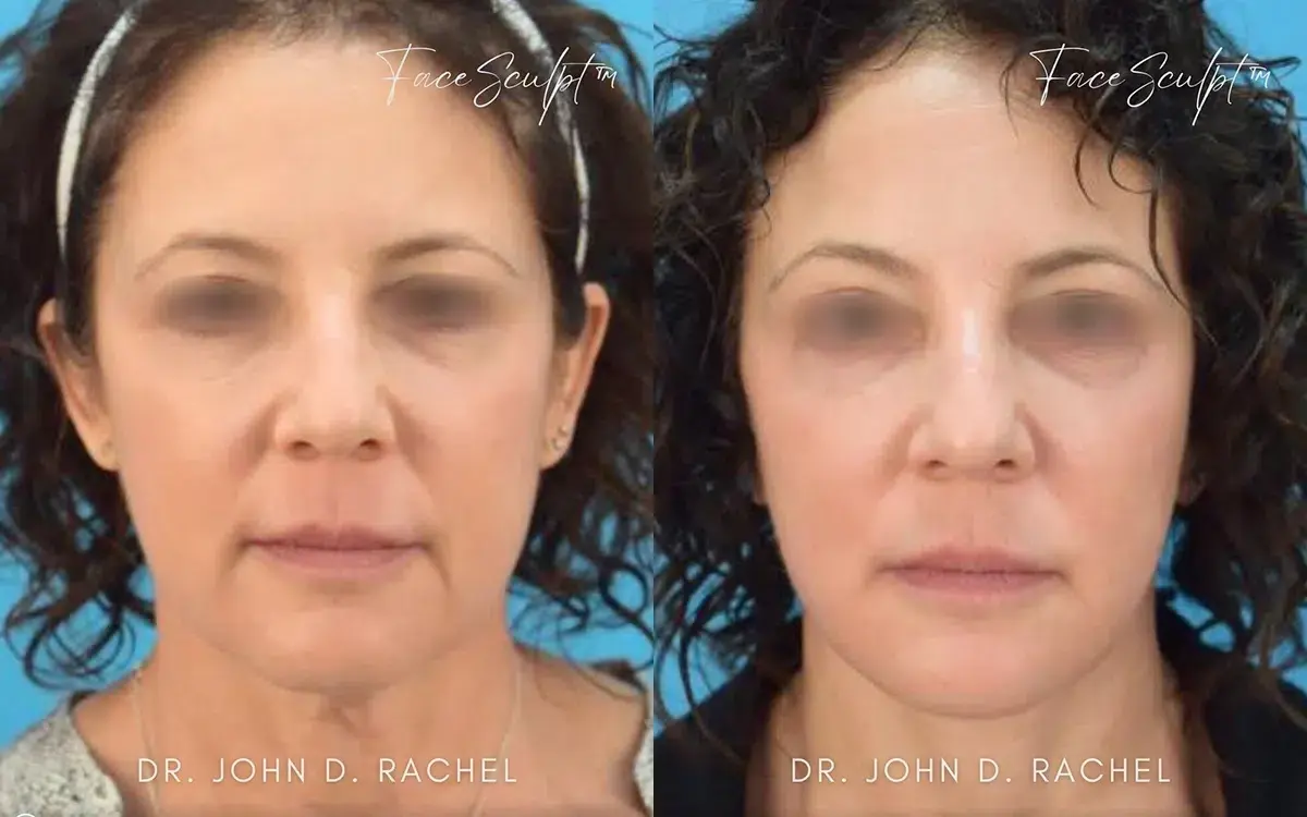 Chicago Aesthetics Surgery & Med Spa facelift result — Chicago, IL