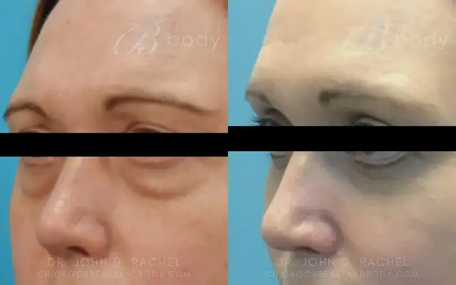 Blepharoplasty result at Chicago Aesthetics Surgery & Med Spa in Chicago, IL