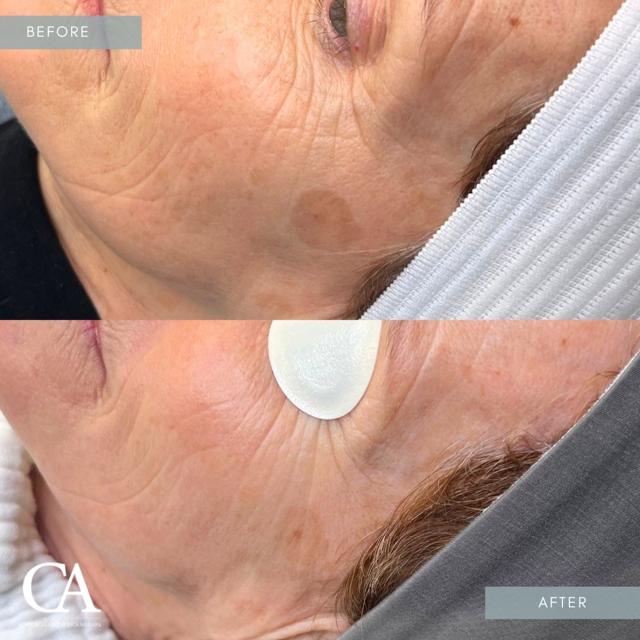 Laser Skin Resurfacing result at Chicago Aesthetics Surgery & Med Spa in Chicago, IL