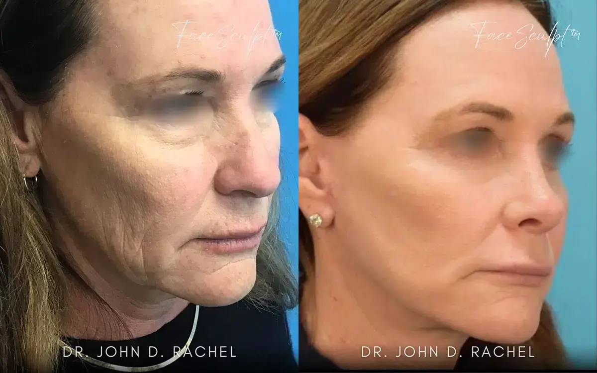 Chicago Aesthetics Surgery & Med Spa facelift result — Chicago, IL