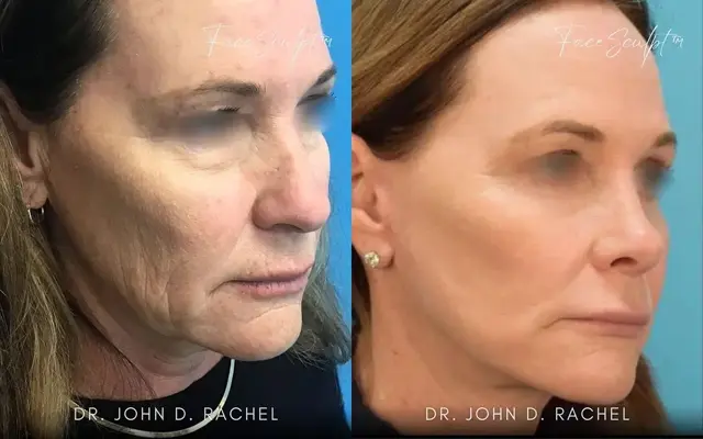 Facelift result at Chicago Aesthetics Surgery & Med Spa in Chicago, IL