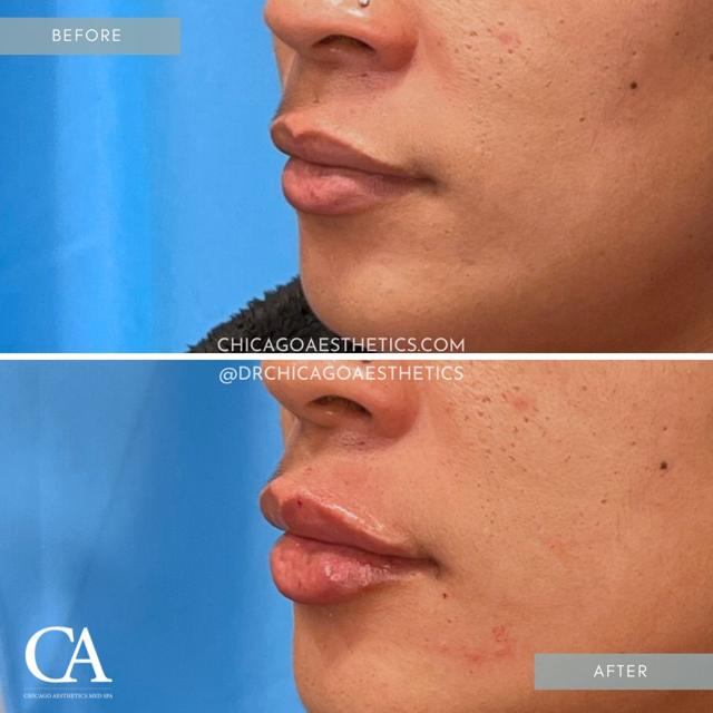 Lip Filler result at Chicago Aesthetics Surgery & Med Spa in Chicago, IL