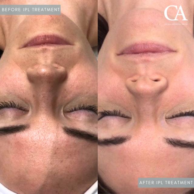 Laser Skin Resurfacing result at Chicago Aesthetics Surgery & Med Spa in Chicago, IL