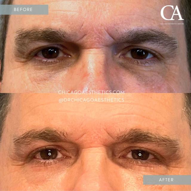 Lip Filler result at Chicago Aesthetics Surgery & Med Spa in Chicago, IL