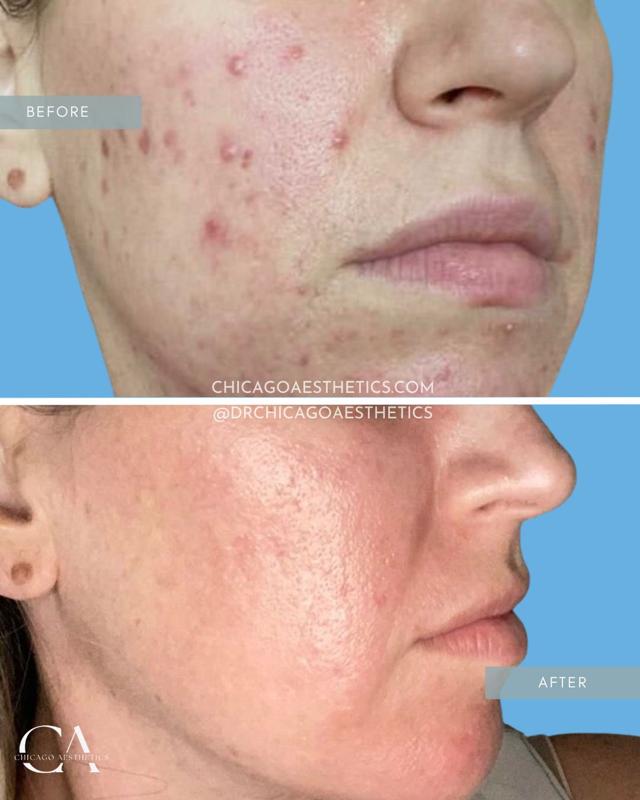 Laser Skin Resurfacing result at Chicago Aesthetics Surgery & Med Spa in Chicago, IL