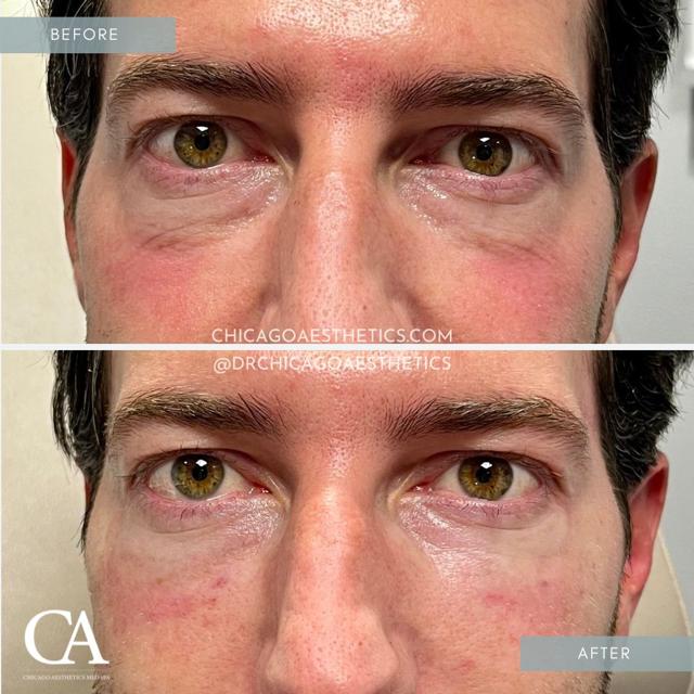 Lip Filler result at Chicago Aesthetics Surgery & Med Spa in Chicago, IL