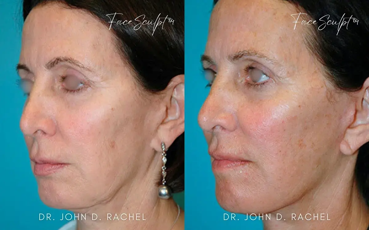 Chicago Aesthetics Surgery & Med Spa facelift result — Chicago, IL