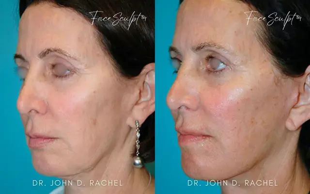 Facelift result at Chicago Aesthetics Surgery & Med Spa in Chicago, IL