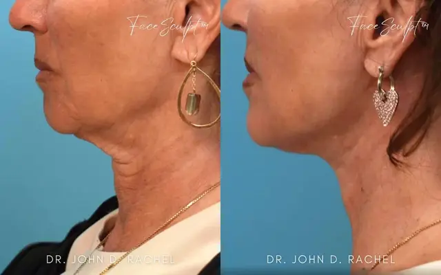 Neck Lift result at Chicago Aesthetics Surgery & Med Spa in Chicago, IL