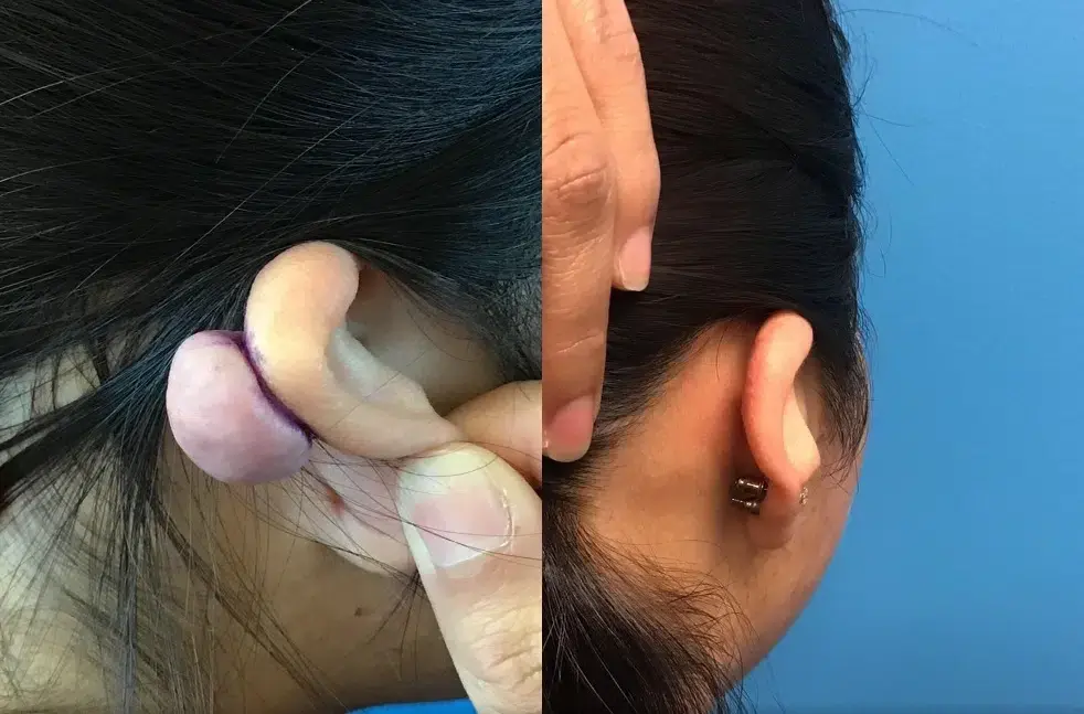 Chicago Aesthetics Surgery & Med Spa scar treatment result — Chicago, IL