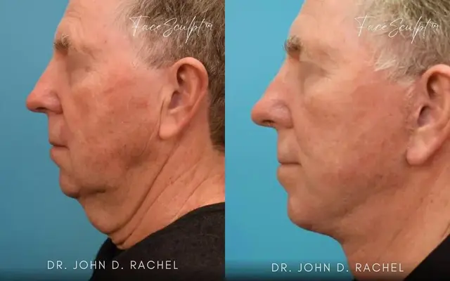 Neck Lift result at Chicago Aesthetics Surgery & Med Spa in Chicago, IL