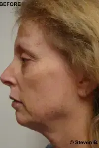 Deep Plane Facelift before at The Center for Cosmetic Surgery and The Washington Hair Institute with Dr. Steven B. Hopping in Washington, DC